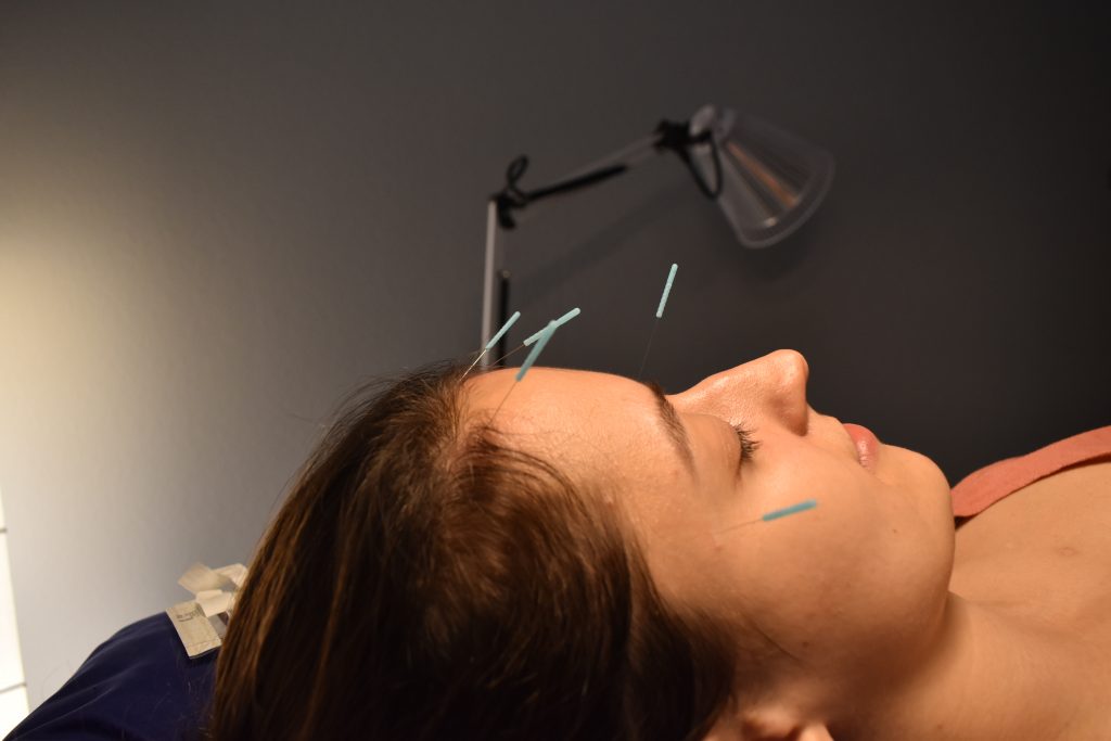 Migraine Headaches! It’s NOT all in your head. - Pins and Needles Acupuncture