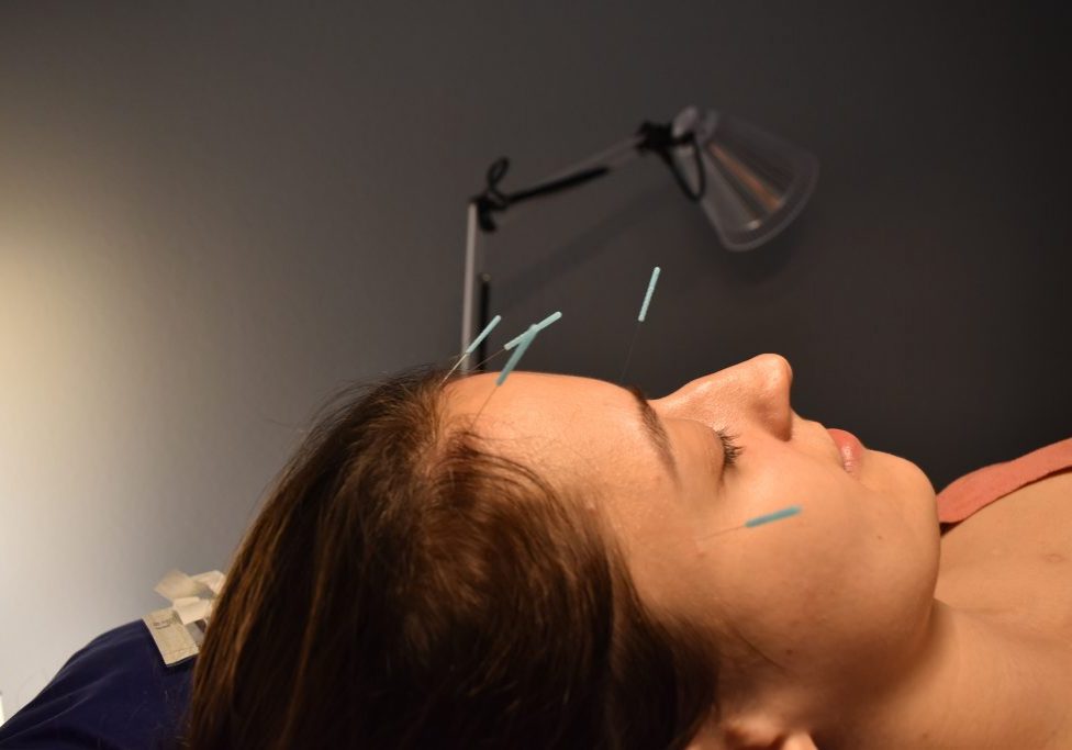 Common points needled for headaches